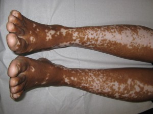 Was ist Vitiligo? - Vitiligo an den Beinen